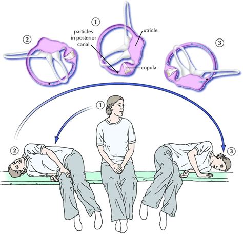 Lie down on your right side. . Positional vertigo exercises video